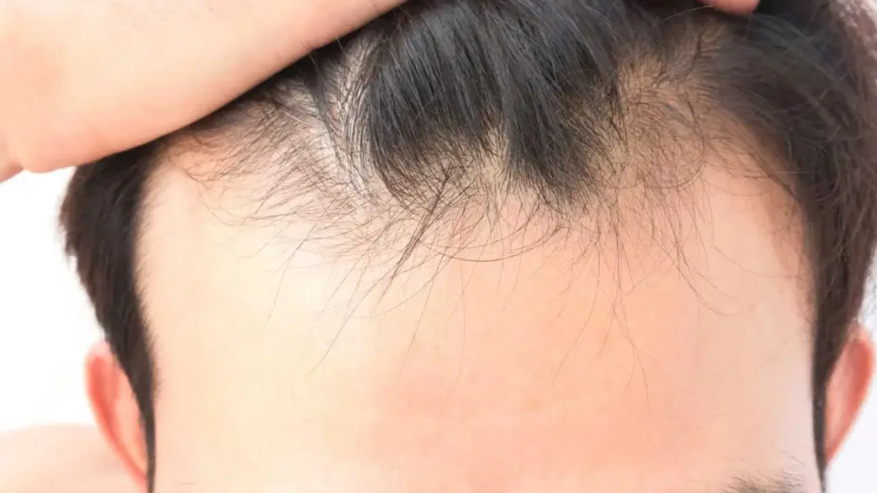 sac dokulmesinde gizli neden vitamin ve mineral eksikligi ne kadar etkili zTtTSOl9.jpg